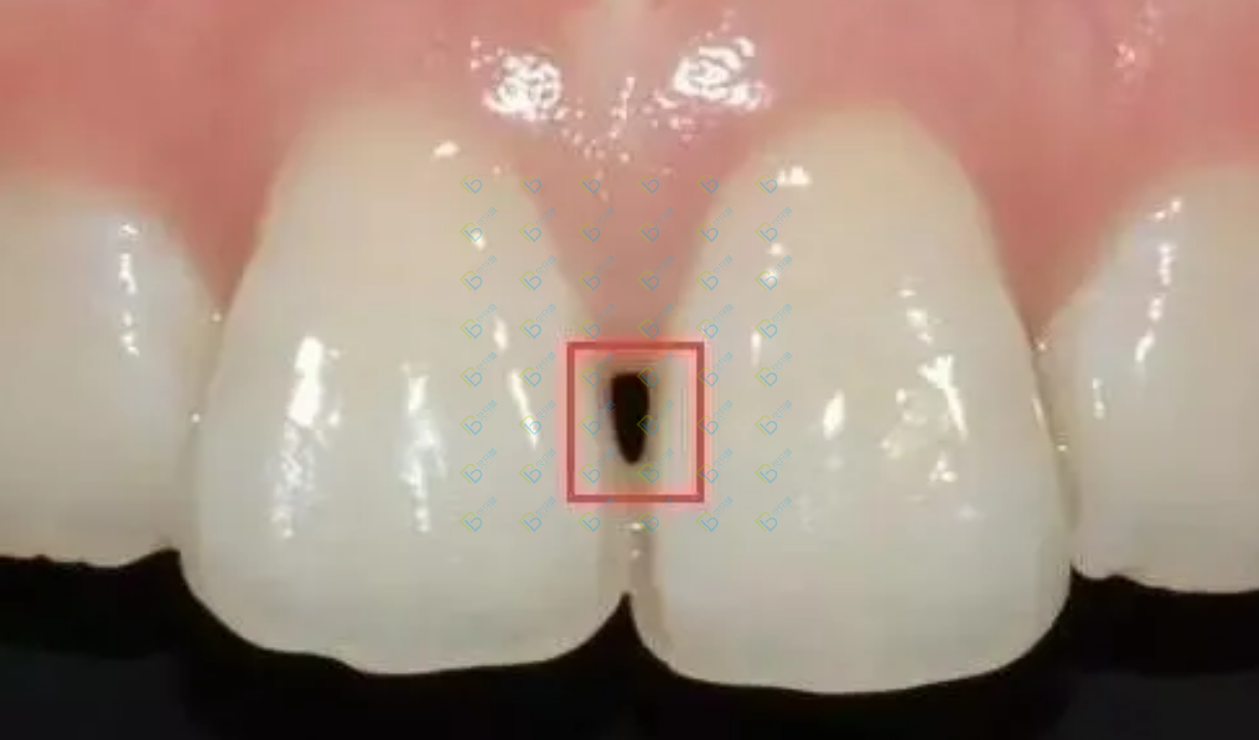 讓人聞風喪膽的牙齒“黑三角”，比齲齒更可怕！