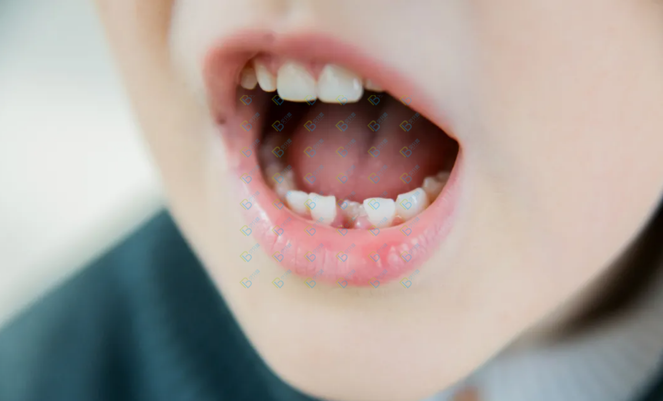 孩子好好的乳牙怎么越長越歪了呢？