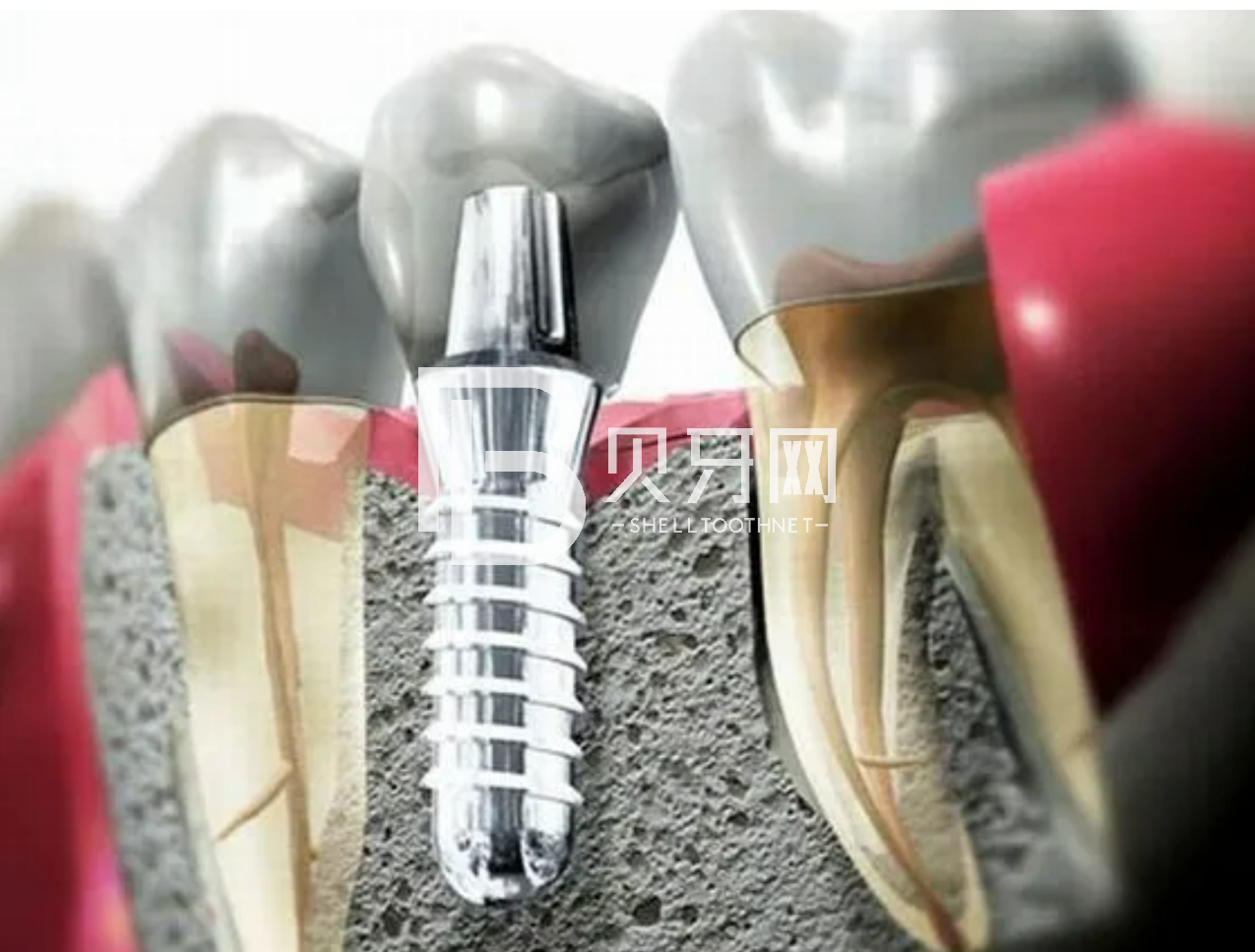 種植牙，真的很可怕嗎？