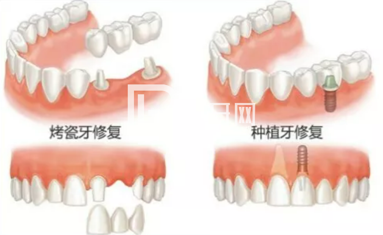 老人種牙對(duì)身體條件有要求嗎？