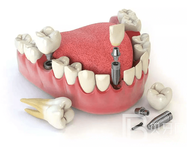 不到60歲，牙齒就所剩無(wú)幾了？這5件護(hù)牙小事，別等老了再做！