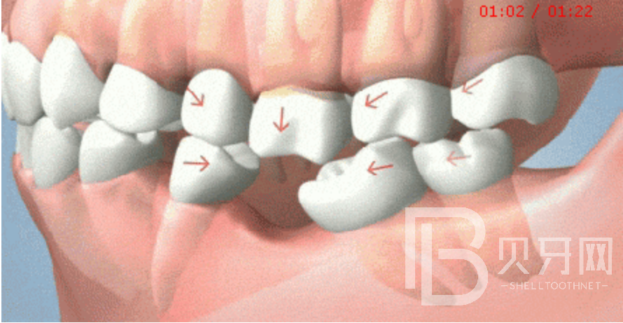 90%不知道，牙齒缺失后，盡然會出現(xiàn)這些癥狀！