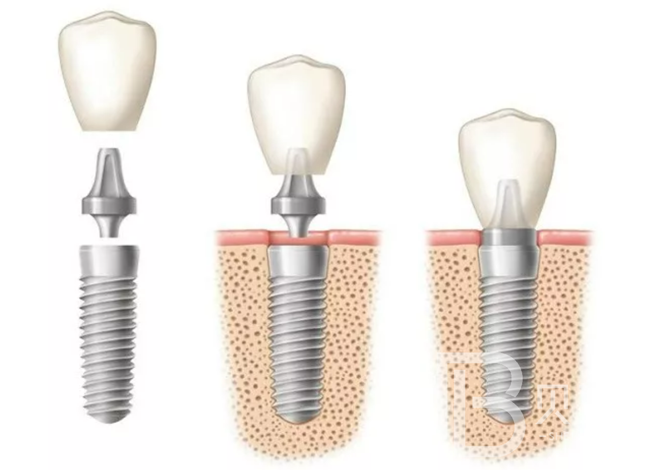 牙齒缺失做種植牙必須要植骨么？