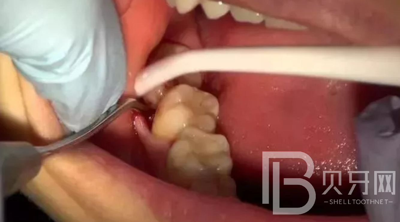 為什么牙醫(yī)建議讓拔掉智齒？