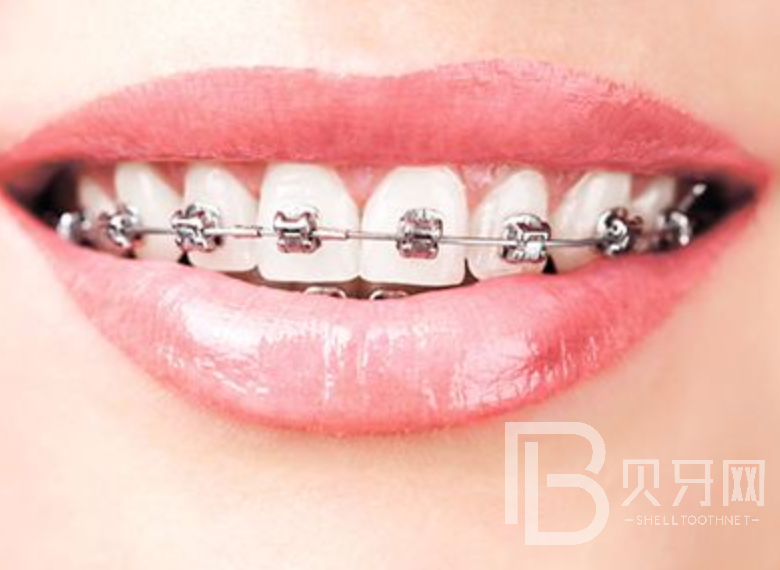 牙齒矯正有風(fēng)險(xiǎn)嗎？來聽聽口腔醫(yī)生怎么說