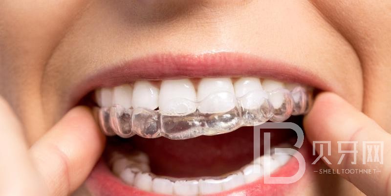 牙齒矯正后容易反彈嗎?這種情況需謹慎！