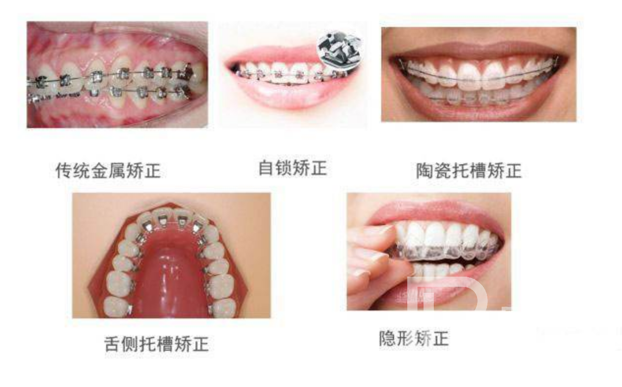 牙齒不整齊都有哪些矯正方式?分別價格多少錢？