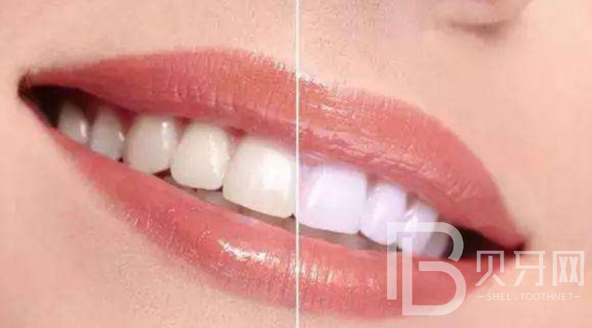 影響牙齒美白的六大食物，你知道是哪六種嗎？