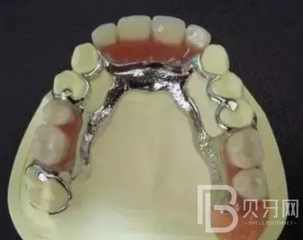 牙齒缺失一顆哪種修復(fù)方式好？