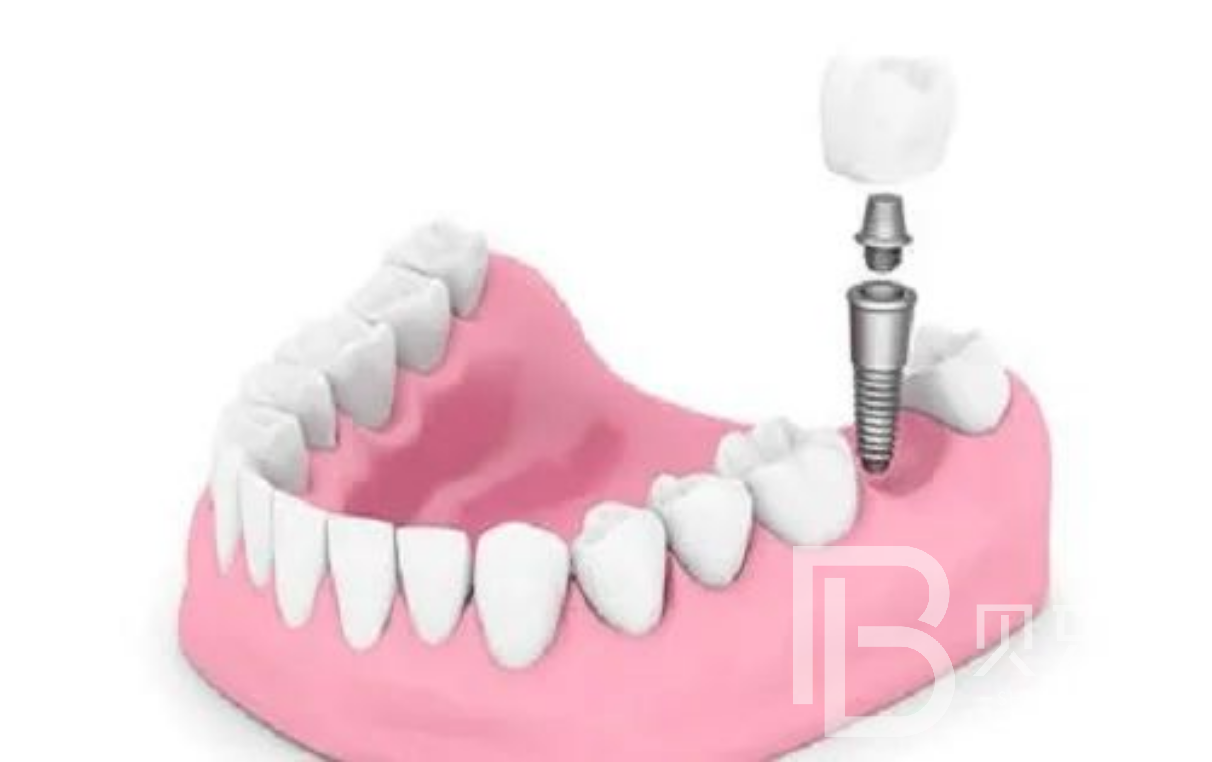 多顆牙缺失做種植牙需要多少錢？