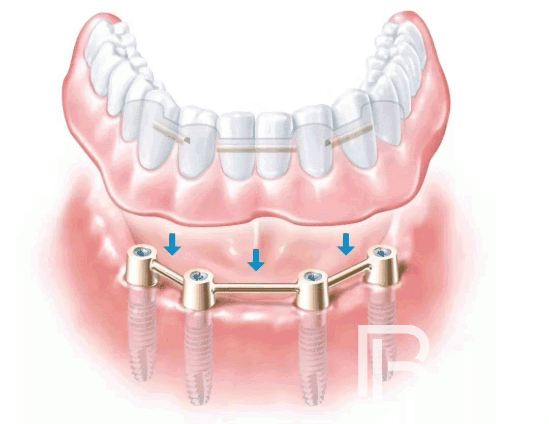種植牙知識科普：All-on-4種植牙的幾個常見問題！