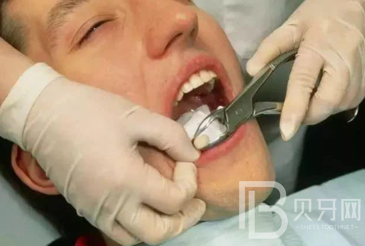 拔牙的注意事項(xiàng)有哪些，這幾個你一定要知道