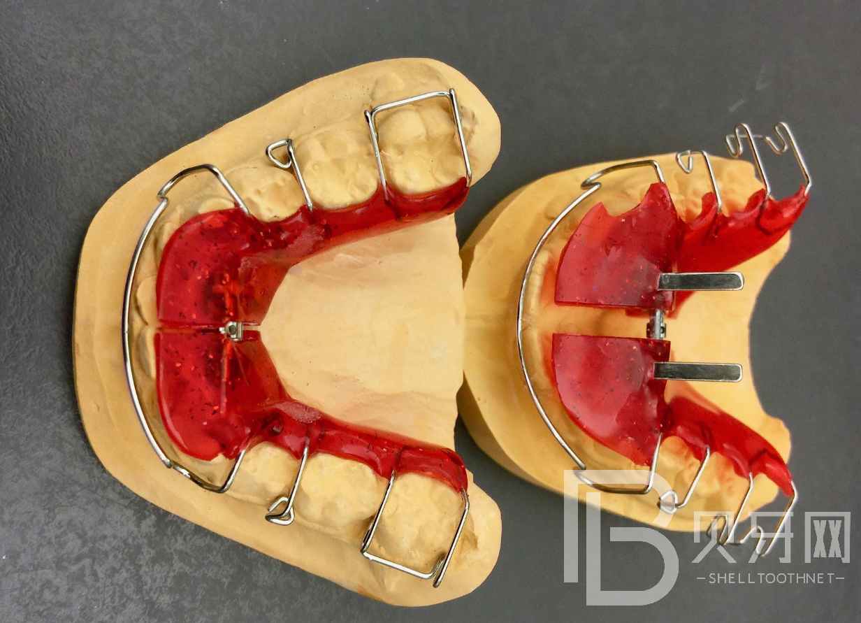 牙齒矯正后怎么樣保持才不會反彈？
