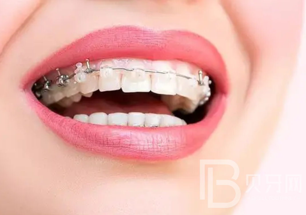 隱形牙套、鋼托槽、陶瓷托槽有什么區(qū)別？