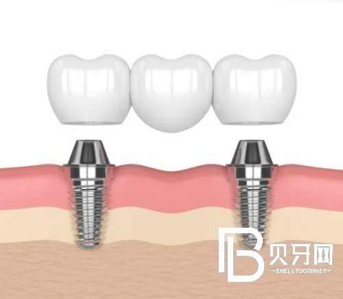 上海種植牙多少錢一顆？種植牙齒哪里比較好？