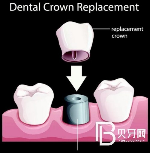 為上海牙齒缺失的市民提供一份全新的全口種植牙價格表