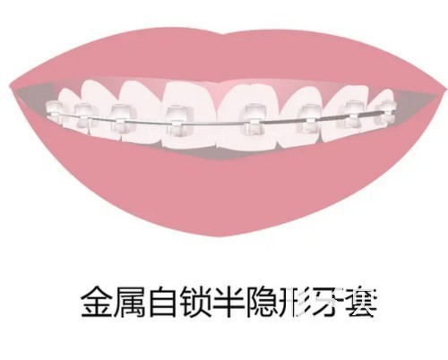 上海牙齒矯正價格表揭秘 五千到五萬都有就看你怎么選擇！