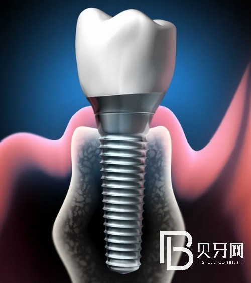 北京種植牙的價格表公布：看看在北京種牙哪里便宜！