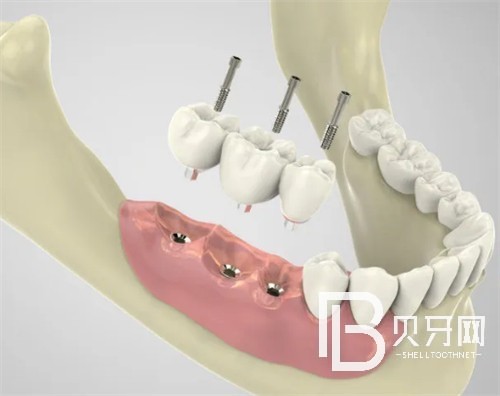 北京中諾口腔醫(yī)院種植牙怎么樣？?jī)r(jià)格貴不貴？