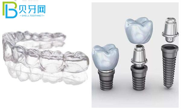 隱形牙套和種植體圖片