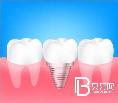 上海雅潔口腔怎么樣？種植牙多少錢(qián)？