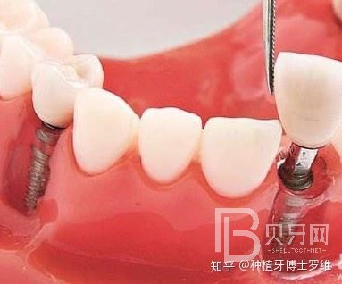 種植牙怎么樣？看看深圳諾德口腔怎么說！