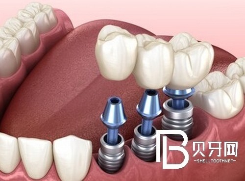 老年種植牙的利與弊？北京維爾口腔種植牙好不好？