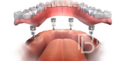 全口種植牙需要種幾棵？北京維樂口腔種植牙技術(shù)怎么樣？