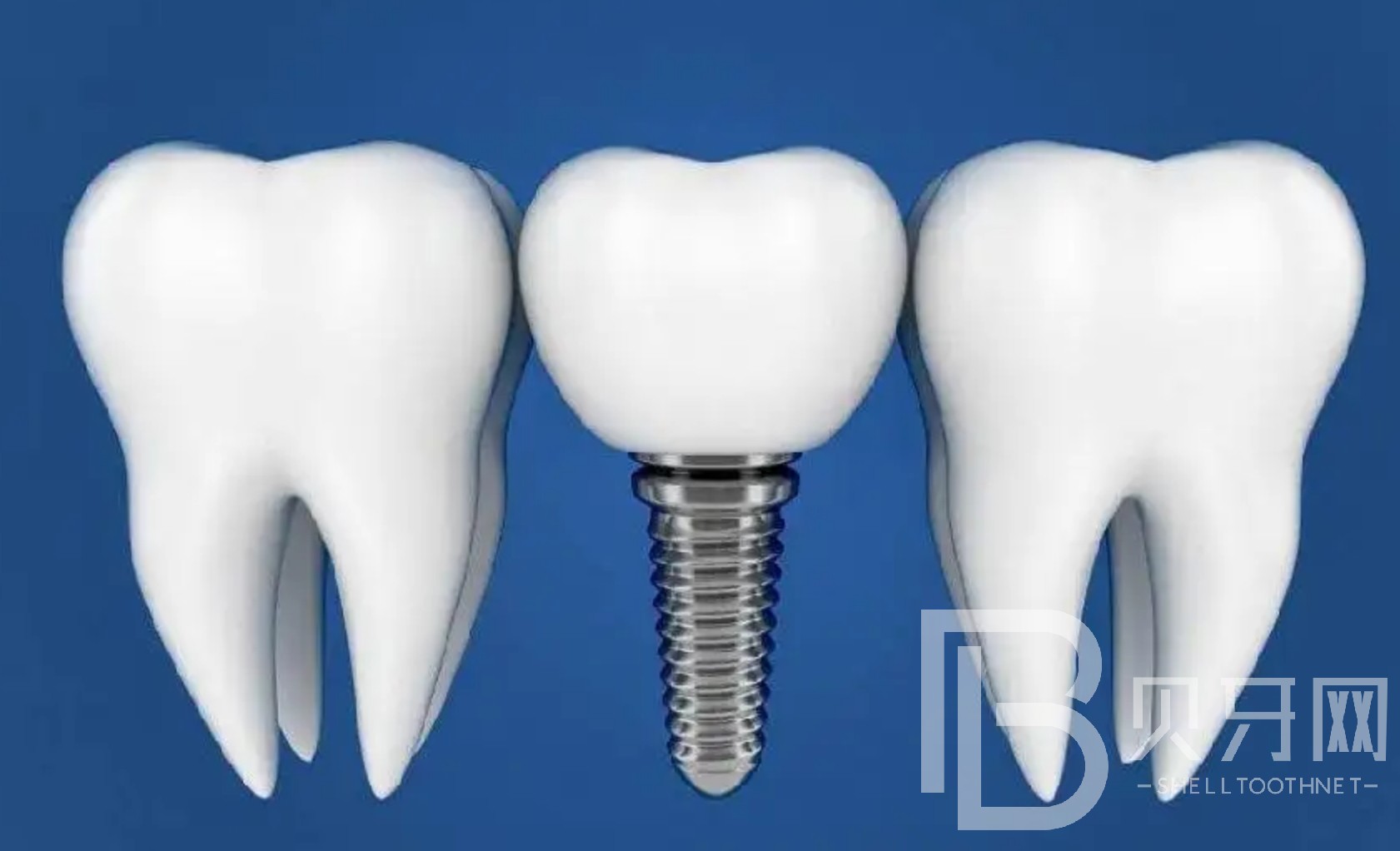 半口種植牙大概要幾次完成？北京美冠塔口腔種植牙怎么樣？