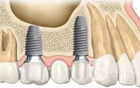 廣州瑞德口腔種植牙怎么樣？廣州瑞德口腔種植牙多少錢