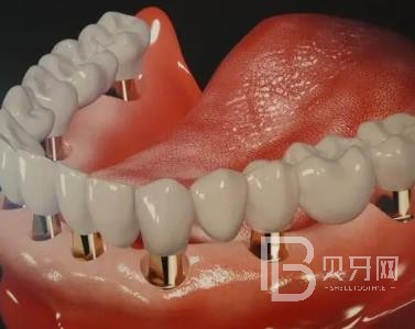 廣州廣大口腔老年人種植牙價(jià)格，全口種植牙需要種幾棵