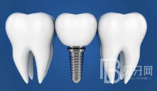 廣州瑞爾口腔老年人能做種植牙嗎？廣州瑞爾口腔價格多少錢