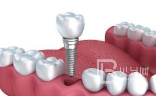 60歲老年人種植牙哪家好？北京鈦植口腔怎么樣？