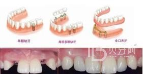 60歲的人種植牙還是鑲牙好？北京冠美口腔怎么樣？