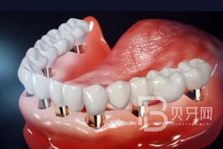 半口種植牙要種幾顆？北京維樂口腔正規(guī)嗎？