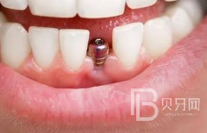 廣州暨博口腔怎么樣？廣州暨博口腔口碑好不好？廣州暨博口腔種植牙價(jià)格