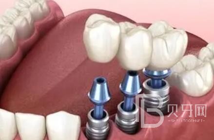 廣州諾爾口腔怎么樣？廣州諾爾口腔種植牙一顆多少錢