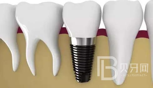 廣州曙光口腔正規(guī)靠譜嗎？醫(yī)院位置在哪？廣州曙光口腔種植牙價格