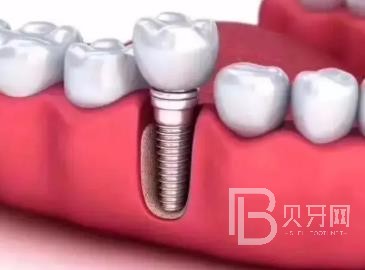 廣州研科口腔醫(yī)院怎么樣？廣州研科口腔口碑好不好？廣州研科口腔種植牙多少錢