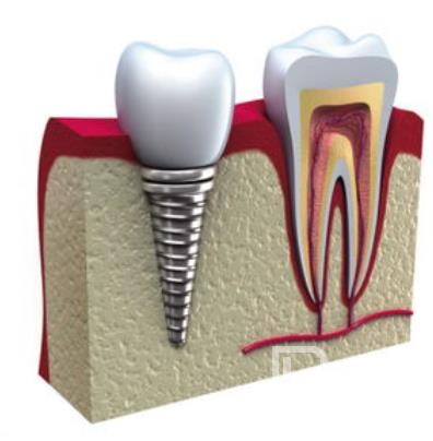 廣州德祥口腔怎么樣？廣州德祥口腔口碑好不好？廣州德祥口腔種植牙價格