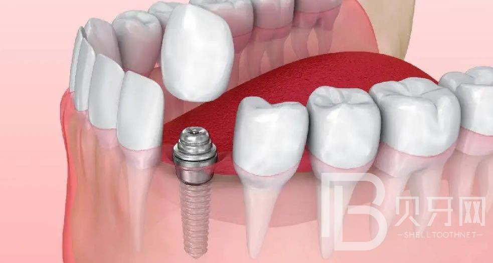 深圳德道口腔關(guān)于種植牙