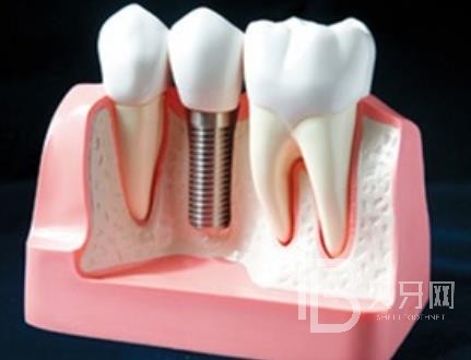 廣州悠美口腔怎么樣？口腔口碑好不好？口腔種植牙價格