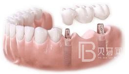 75歲老人適不適合做種植牙？北京圣貝口腔怎么樣？