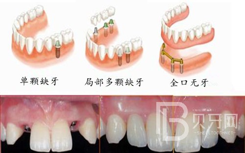 半口種植牙一般需要幾個階段？北京德貝口腔種植牙正規(guī)嗎？