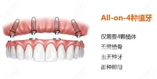 滿口種植牙需要種幾顆？北京佳美口腔正規(guī)嗎？