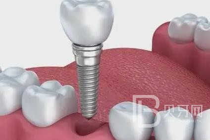 廣州愛威白口腔怎么樣？廣州愛威白口腔口碑好不好？廣州愛威白口腔種植牙價格