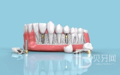 廣州六月微笑口腔怎么樣？廣州六月微笑口腔口碑好不好？廣州六月微笑口腔種植牙價格