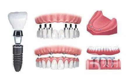 半口種植牙需要幾個(gè)種植體？北京牙管家口腔怎么樣？