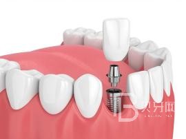 老年人適合種植牙么？北京薇琳口腔種植牙怎么樣？