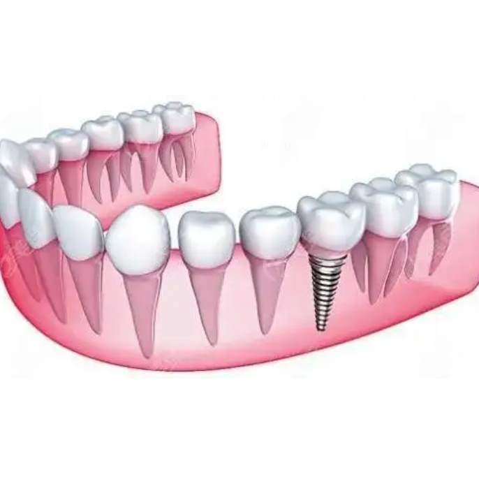 杭州種植一顆假牙多少錢！杭州聞喜淇杰口腔醫(yī)院(余杭古墩路口腔診所)種植牙價(jià)格表?yè)屜瓤?，?guó)產(chǎn)拜阿蒙種植牙：2371元起/顆！